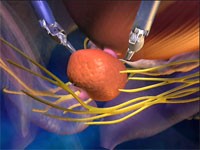 prostate with robotic arms prostate with robotic arms