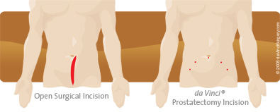 prostatectomy_comparison395x159 prostatectomy incision and open surgical incision comparison